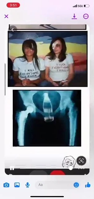 Phone video screenshot of two women wearing printed shirts above a blue X-ray-style pelvis image.