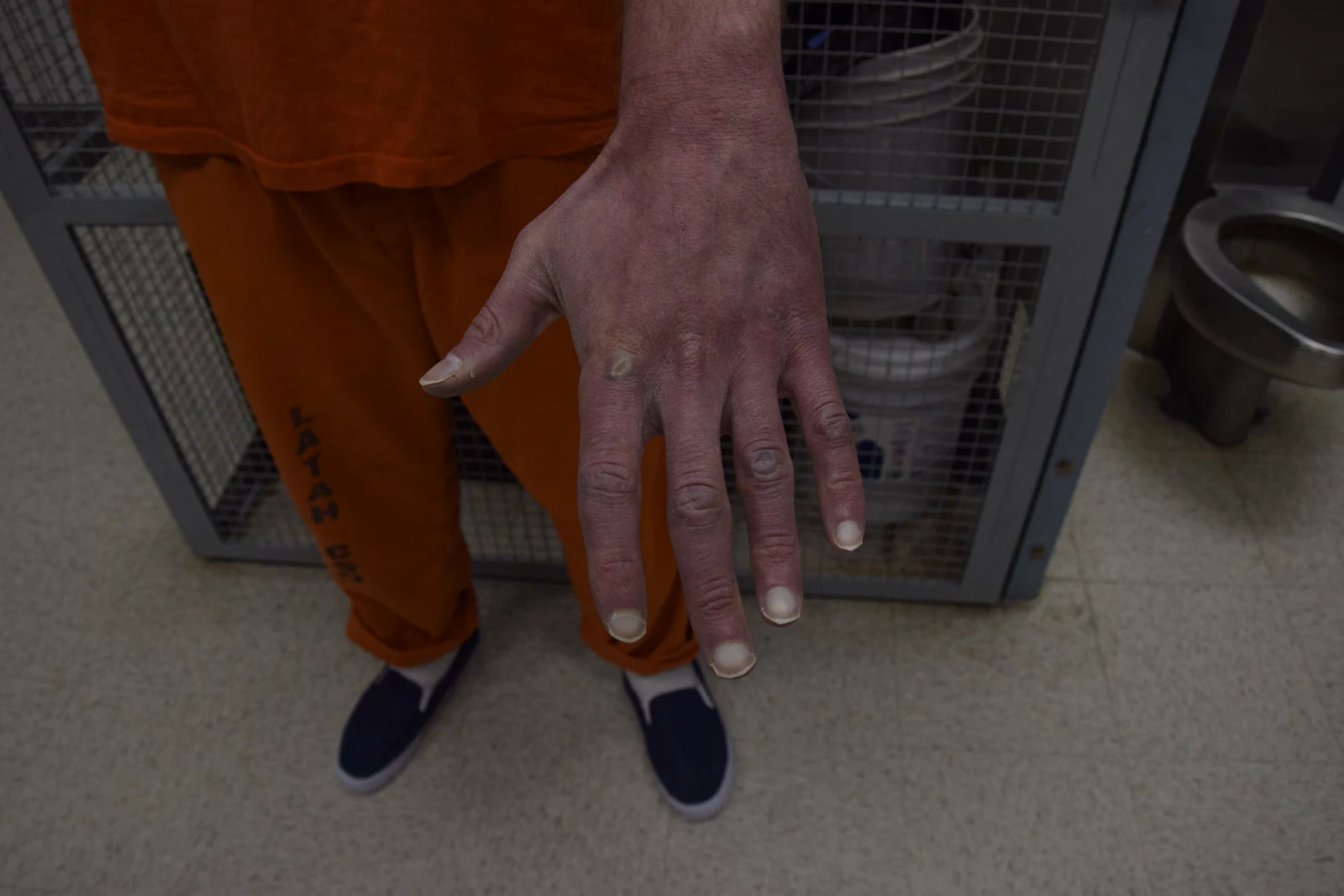 Downward view of the back of a hand with spread fingers and small pale spots, with orange trousers and blue shoes below.